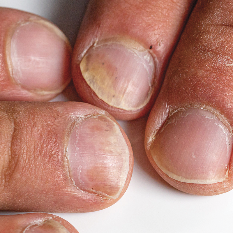 Les dangers du décollement des ongles (onycholyse) et comment l’éviter — free download
